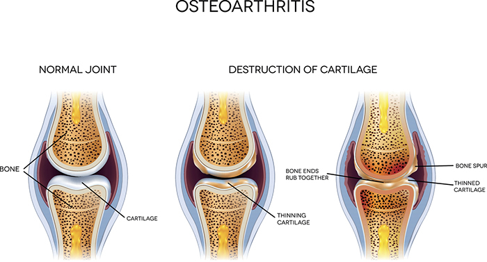 arthrose