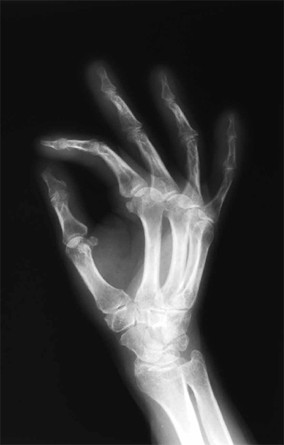 arthrose